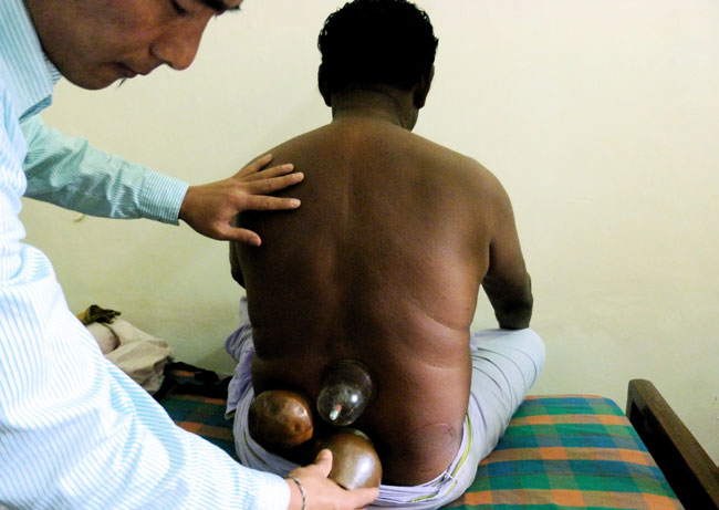 Dr Tara Ngawang Lodoe does cupping on a patient during the 11th Tibetan Medical Camp at Kochi. Dr Tara Ngawang Lodoe escaped to India in 1989 to study Tibetan Buddhism and Philosophy at the Sera Jhe Monastery and earned a Degree in Tibetan Medicine from the Tibetan Medical and Astrological Institute of His Holiness the Dalai Lama. (Photo: Sylvie Bantle)